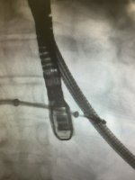 Ameliyatsız Kalp Kapak Onarımı - 251115