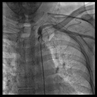 Artery Occlusion Treatment - 437