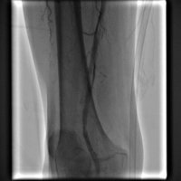 Leg Artery Occlusion Treatment - 1133