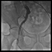 Leg Artery Occlusion Treatment - 79