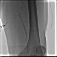 Leg Artery Occlusion Treatment - 82