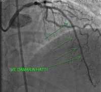 Kronik tıkalı kalp damarı- 171002